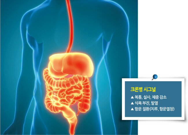 크론병은 입에서 항문까지 모든 소화관에서 발생할 수 있는 만성 염증성 질환이다. [GETTYIMAGES]