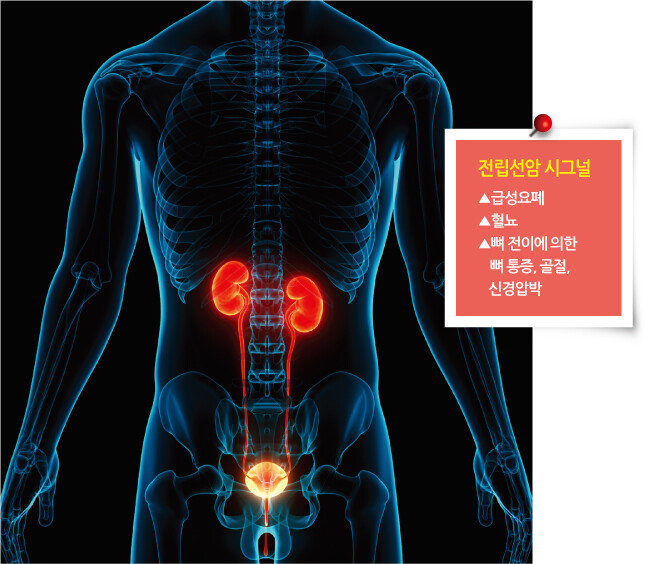 남성 생식기관 중 하나인 전립선(전립샘)에 발생하는 전립선암. [GETTYIMAGES]
