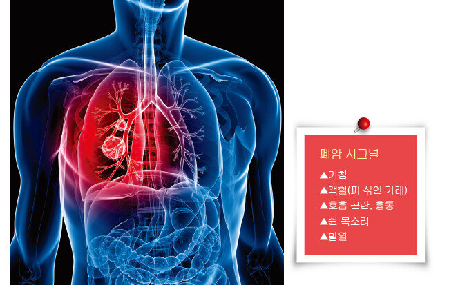 폐암에 걸릴 확률은 흡연자가 비흡연자에 비해 10배 이상 높다. 피우는 담배 양이 많을수록, 흡연을 일찍 시작할수록, 흡연 기간이 길수록 폐암 발병률이 높아진다. [GettyImages]