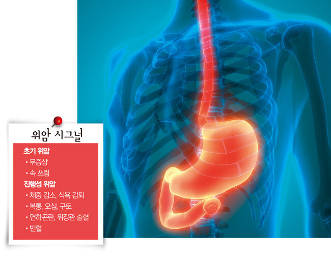 위암 초기에는 약 80%가 무증상이며 가벼운 속 쓰림이나 만성 소화불량 같은 비(非)특이적인 증상이 나타난다. [GETTYIMAGES]