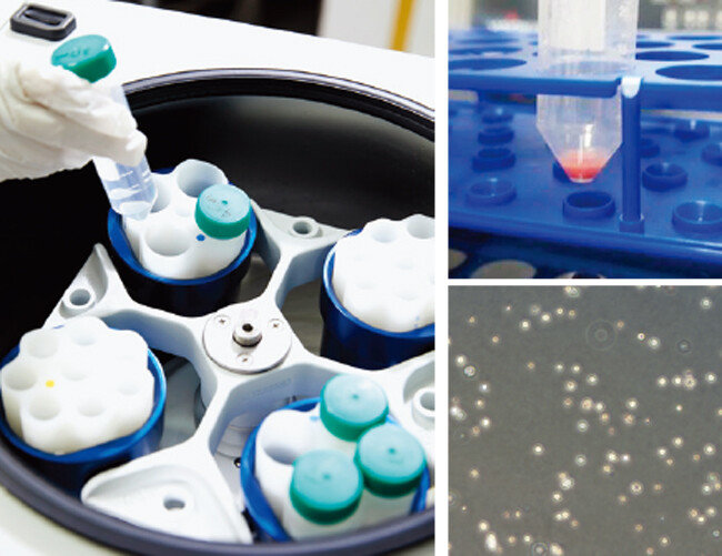 중간엽 줄기세포 추출에 사용되는 원심분리기. 오른쪽은 추출된 자가지방 줄기세포의 추출액(위)과 현미경 사진. [홍중식 기자. 연세사랑병원 제공]