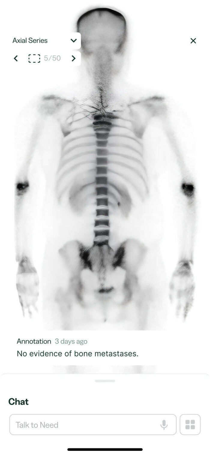 니드의 암보호시스템 앱 화면. 영어로 “뼈 전이 증거가 없습니다”라고 적혀 있다. 니드 제공
