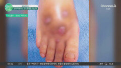 당뇨병 환자 600백만명 넘어 당뇨병 환자 600백만명 넘어