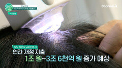 탈모 치료에 건강보험 적용될까?