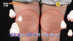 [예고] 병든 지방과 염증살이 내 몸에? 셀룰라이트 없애는 셀 제거 프로젝트