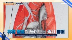 촉촉한 폐 유지가 필수인 여름철! 볶음 맥문동 진액으로 폐에 들어오는 유해 물질을 차단한다!