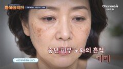 [예고] 중년 피부 노화의 흔적 기미! 치명적인 피부암 흑색종일 수 있다?