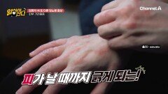 식곤증 외에 또 다른 당뇨병 증상? 피가 날 때까지 긁게 되는 가려움증