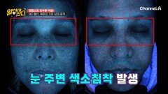 눈을 비비는 행동은 눈 주변 색소침착의 원인이 된다?! 염증으로 피부톤 악화한 두 MC들!
