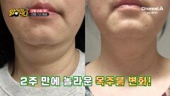 [예고] 2주 만에 놀라운 목주름 변화! 목주름 개선을 도와준 이것의 정체는?