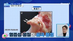 연골을 자극해 통증을 유발하는 뼈 돌기? 관절 파괴를 가속화 하는 염증