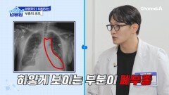 피부가 함몰이 된다!? 생명까지 위협하는 부종의 공포