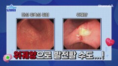 약 6년 만에 위암으로 발전!? 위암의 위험을 높이는 위암의 씨앗, 위염