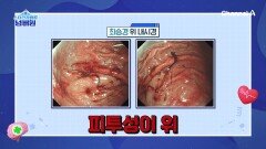 후두와 식도부터 만신창이ㅠㅠ 피투성이 위의 계보를 잇게 된 최승경!?
