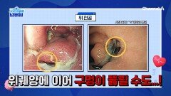 흔해서 방치하다가 위암의 씨앗이 되는 위염?!