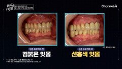 잇몸뼈가 내려앉은 상황?! 충격적인 치아 상태! 생존 프로젝트 후 몰라보게 달라진 그녀의 입속 건강!