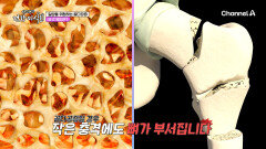 넘어졌는데 뼈가 으스러질 정도면 골다공증?