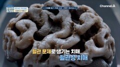 치매를 막기 위해 '모세혈관' 관리는 필수?! 흔한 건망증 증상을 무시하면 안 되는 이유