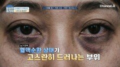 눈 밑 다크써클을 무시해선 안 된다?! 아무도 몰랐던 모세혈관 건강의 적신호