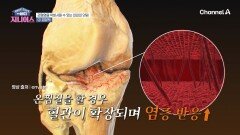 ※충격※ 찜질팩이 관절염을 악화시킨다? 관절염을 악화시키는 의외의 잇템