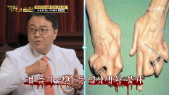중년 여성의 삶을 무너뜨리는 관절 부위 '손가락과 발목' TV CHOSUN 221122 방송