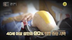 3mm 연골이 보내는 위험시그널_인생의 연장전 114회 예고 TV CHOSUN 241030 방송