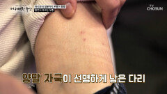 특별한 이유 없이 퉁퉁 붓는 몸 원인은 알부민 부족⁉ TV CHOSUN 260101 방송