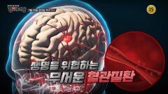 심뇌혈관 질환의 위협에서 벗어날 방법은?_메디컬다큐 명의보감 57회 예고 TV CHOSUN 240726 방송