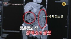 장운동의 적 장독소의 공포_메디컬다큐 명의보감 133회 예고 TV CHOSUN 260327 방송