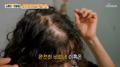 빠지는 머리카락만큼 줄어드는 자신감 영원히 숨기고 싶은 고민 탈모 TV CHOSUN 260221 방송