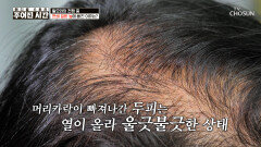 가발 없이 살아갈 수 없는 그녀의 소원은 더 이상 머리카락이 빠지지 않는 것 TV CHOSUN 260221 방송