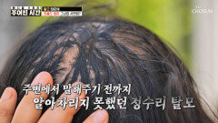 모자부터 가발까지 어떻게든 숨기고 싶은 고민🫣 탈모 TV CHOSUN 260523 방송