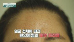 얼굴 전체를 덮은 트러블 피부 노화의 주범은 무엇일까? | JTBC 240421 방송