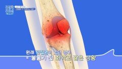 일상적인 동작도 불가 '퇴행성 관절염'이 더 심해지는 경우는? | JTBC 251027 방송