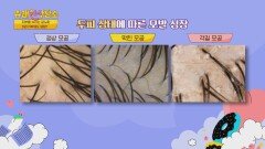 삶의 질까지 하락.. 모발 손상으로 인한 탈모 | JTBC 220524 방송