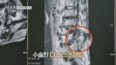 수술한 허리 디스크가 재발한 어머니의 건강 상태 | JTBC 230224 방송