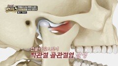 입을 벌릴 때 턱에서 나는 딱딱 소리! 턱 관절염일 수도 있다?! | JTBC 260523 방송