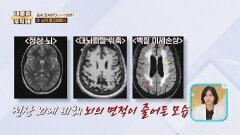 뇌가 쪼그라든다? 치매 위험성↑ 알부민이 부족하면 생기는 현상 | JTBC 260129 방송