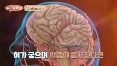 혹시 나도...? 뇌졸중이 보내는 시그널 알아보기 | JTBC 260325 방송