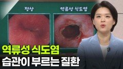 태정현 소화기내과 교수, 습관이 부르는 질환 ‘역류성 식도염’ | KBS 260312 방송 