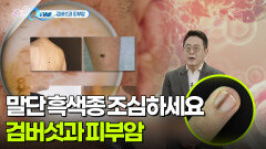  [Q터뷰] 검버섯과 피부암 어떻게 구분할까 | KBS 251127 방송 