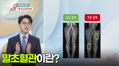 [닥터의 경고] 말초순환장애 | KBS 251215 방송 