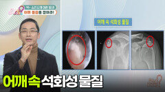 [백년습관] 어깨 통증으로 일상생활이 힘들어요 | KBS 251231 방송 