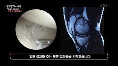 작은 충격에도 부상을 당할 수 있는 골절과 인대 파열 | KBS 240703 방송