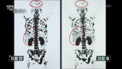 거세 저항성 전립선암 환자, 희망은 있다 | KBS 251015 방송 