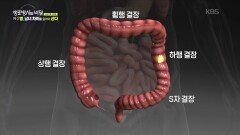 대장암도 성별 따라 다르다?! | KBS 260107 방송 