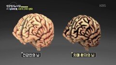 같은 병, 다른 치료가 필요하다! | KBS 260114 방송 