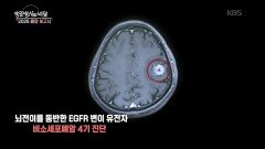 생존력을 개선시킨 병용 요법 | KBS 260128 방송 