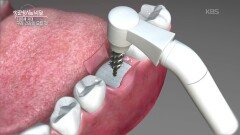 100세 시대, 구강 건강의 모든 것 | KBS 260211 방송 