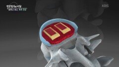 척추, 척수종양의 초기 증상과 특징 | KBS 260225 방송 